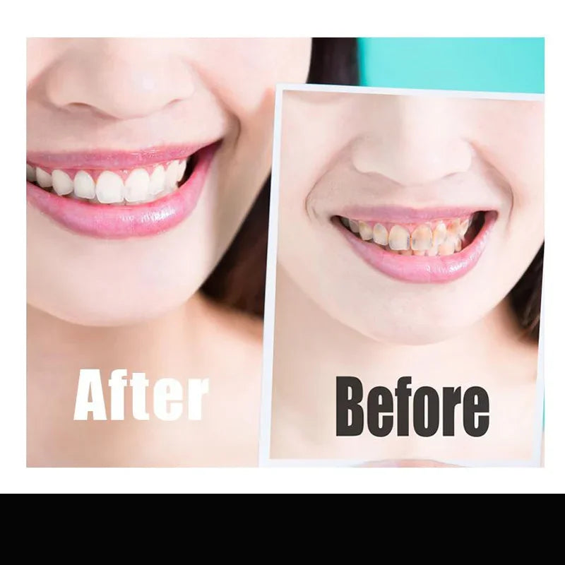 Charcoal Teeth Whitening Strips – 14pcs Kit for Stain Removal from Coffee, Tea & More | Dental Whitening for Men & Women