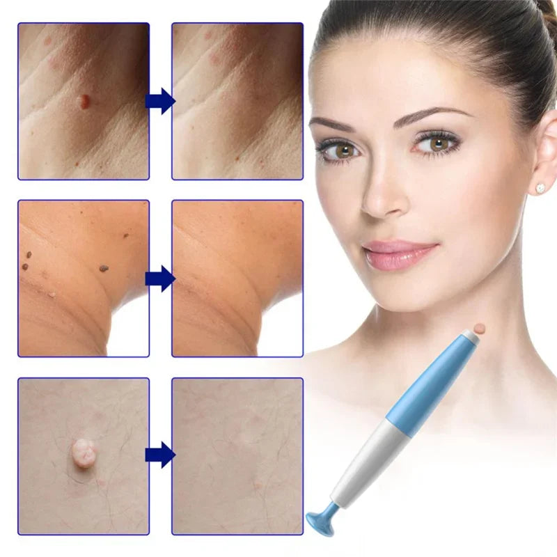 Skin tag and mole removal kit with precision tools for safe 2–4mm skin tag treatment and facial care