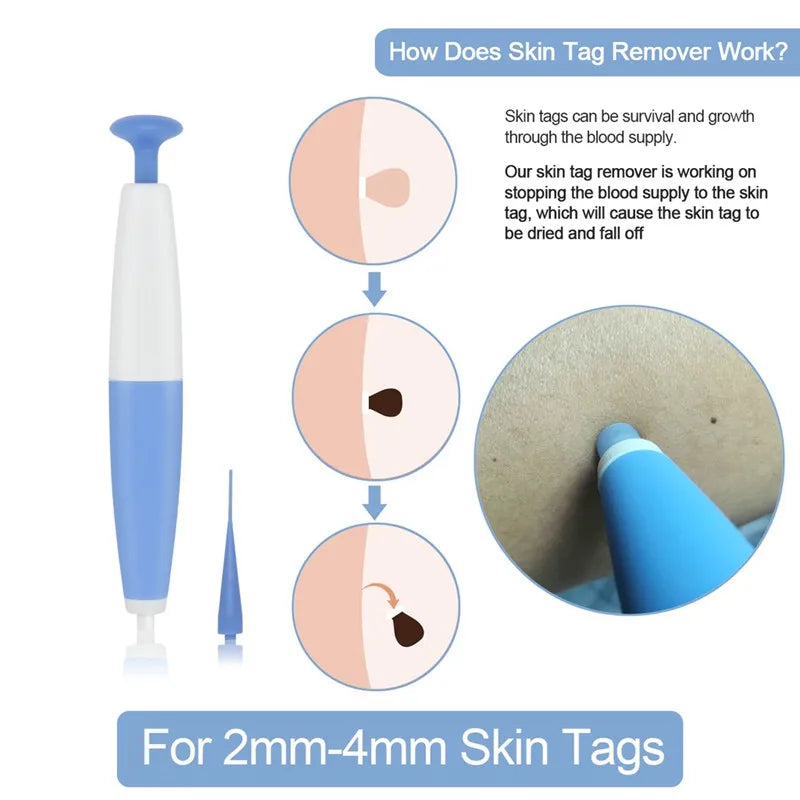 Advanced Skin Tag & Mole Removal Kit – Precision Skin Cleansing Tool for 2–4mm Tags & Warts