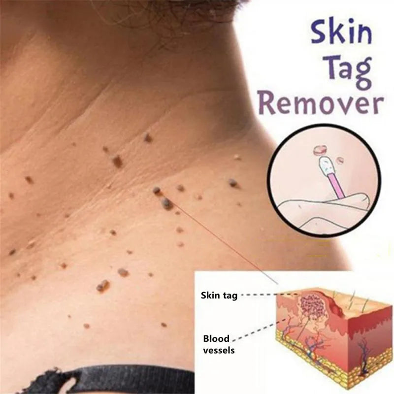 Advanced Skin Tag & Mole Removal Kit – Precision Skin Cleansing Tool for 2–4mm Tags & Warts