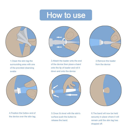 Advanced Skin Tag & Mole Removal Kit – Precision Skin Cleansing Tool for 2–4mm Tags & Warts