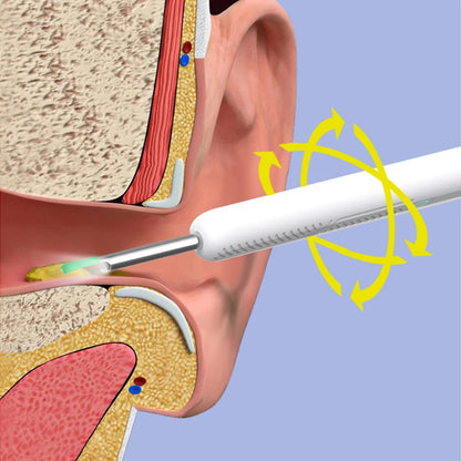 Visual Ear Cleaner with 1296P Camera & 6 LED Lights - Wireless WI-FI Smart Ear Wax Removal Tool with USB-C Charging