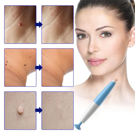 Skin tag and mole removal kit with precision tools for safe 2–4mm skin tag treatment and facial care